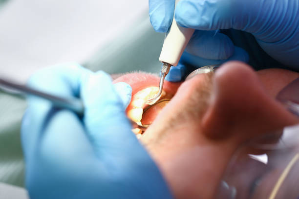 Best Emergency Dental Extractions in Whitehouse, OH